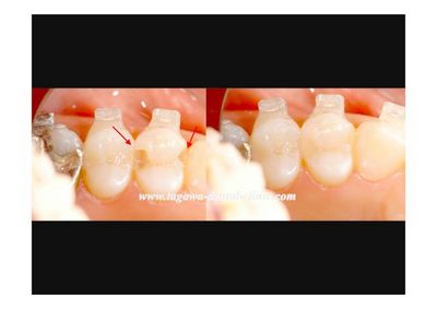 矯正治療中に発見された虫歯をダイレクトボンディングで治療した症例